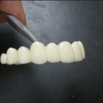 CORONA IN ZIRCONIO
